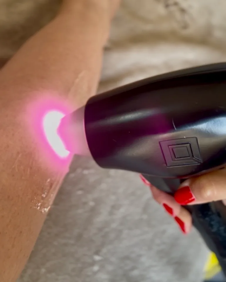 Epilazione laser al diodo